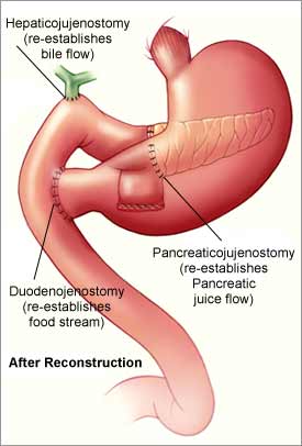 How long does recovery take after pancreatic surgery?